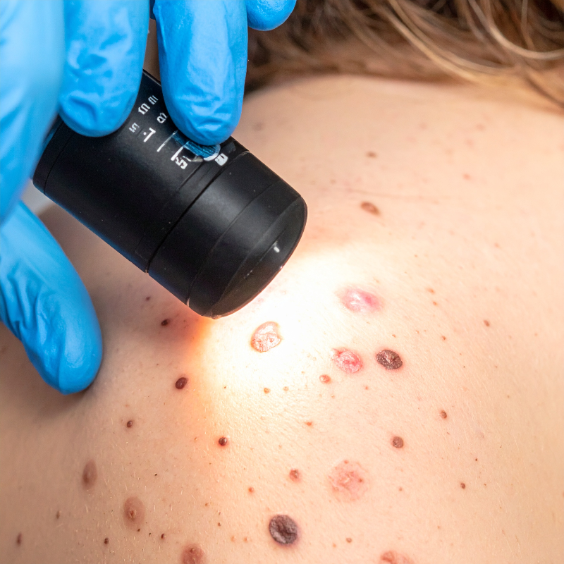 Gros plan peau avec taches à surveiller, examen dermatologique